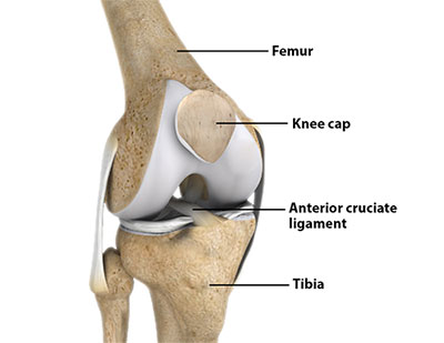Pressfit Knee Replacements